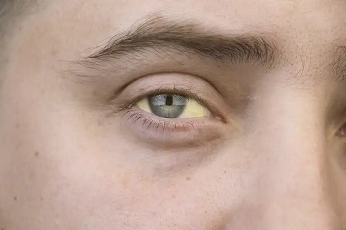 Persoană cu ochi galbeni