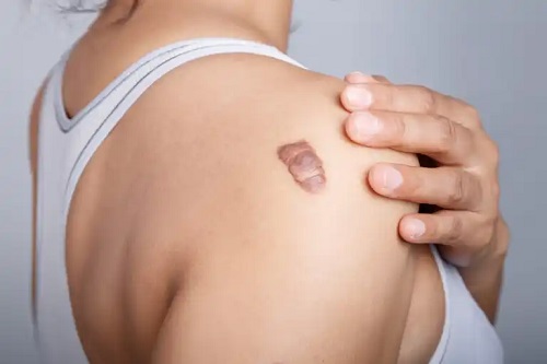 Riscul îndepărtării tatuajelor cu laser implică cicatrici