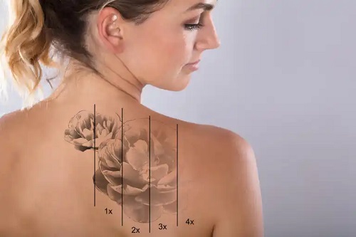 Care este riscul îndepărtării tatuajelor cu laser?