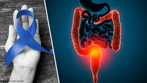 Simbolul cancerului colorectal