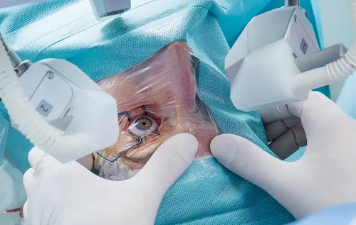 Specialist care analizează efecte secundare ale operației de cataractă