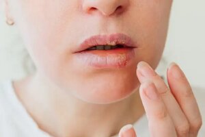 Tratamente pentru herpesul labial