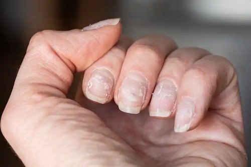 Unghii exfoliate la mâini