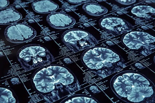 Aspecte neînțelese ale bolii Alzheimer