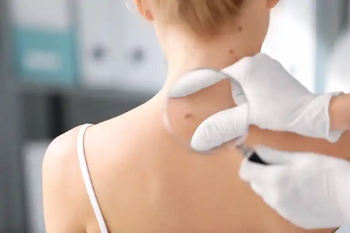 Medic care examinează un nodul pe spate