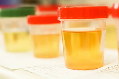 Unele medicamente schimbă culoarea urinei