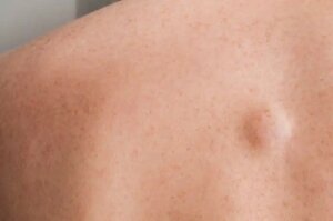 Nodul pe spate: 7 cauze posibile