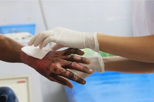 Specialist care tratează o arsură