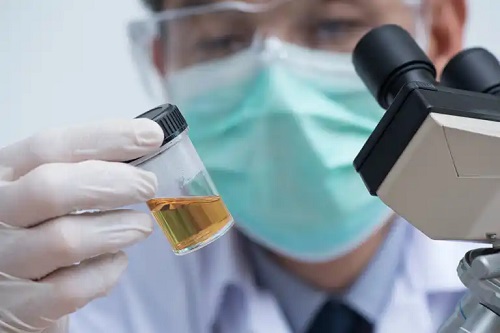 Specialist care verifică urobilinogenul în urină
