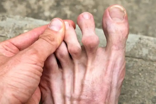 durerea la degetul mare de la picior