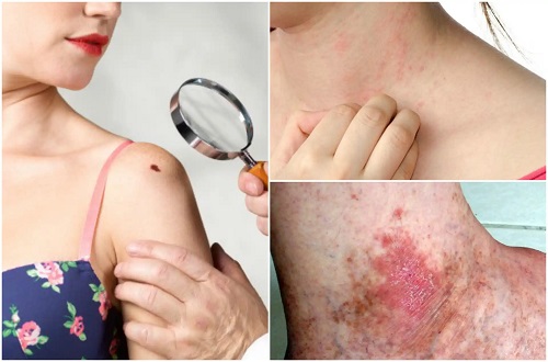 Medic ce caută tratamente pentru carcinomul cu celule scuamoase