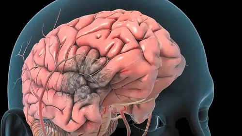 Tromboza arterială cerebrală: ce este, cauze, simptome și tratament