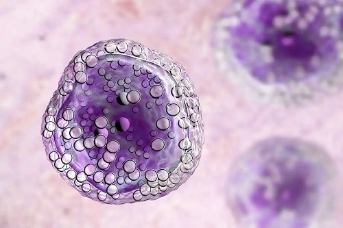 Celule care apar în limfom