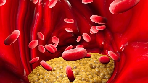 Acumulare de colesterol în sânge