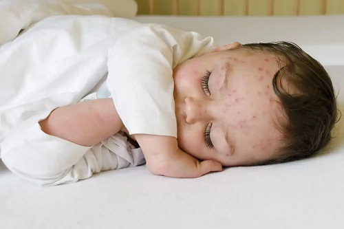 Copil afectat de virusul fratelui mare sau citomegalovirus