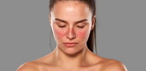 Fată care are lupus
