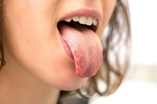 Femeie cu limba uscată