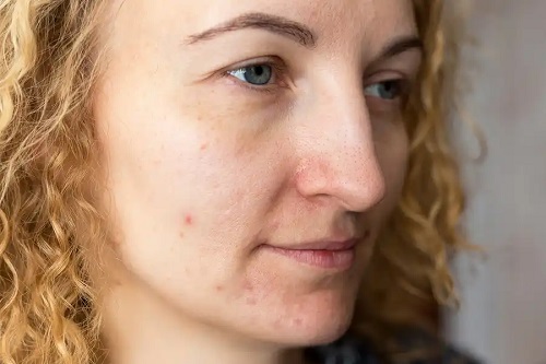 Femeie care folosește tratamentul melasmei