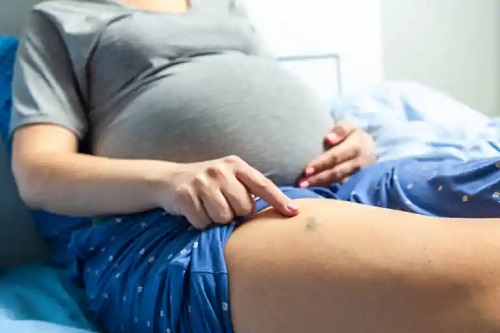 Flebita în sarcină: simptome și tratament