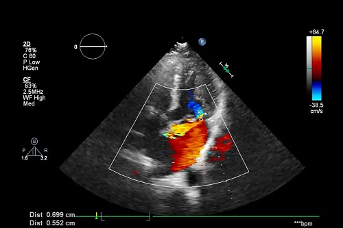 Flebita în sacină la ecografie