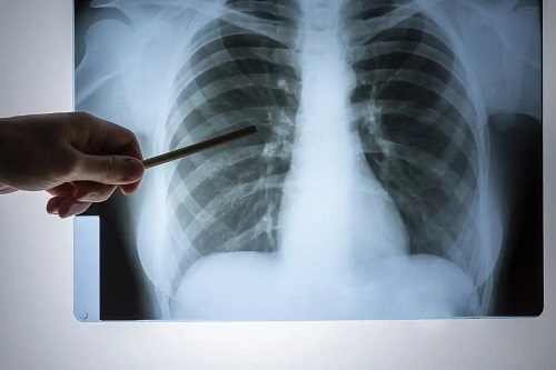 Medic care analizează durerea în partea dreaptă a pieptului
