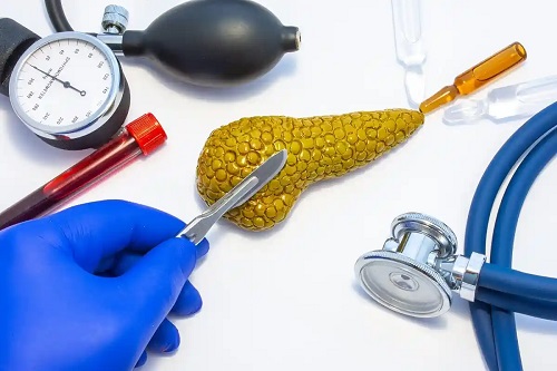 Medic specializat în tratamentul chisturilor pancreatice