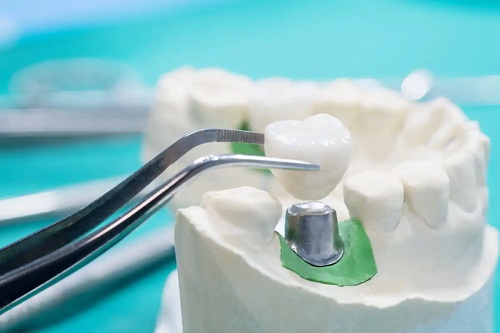 Model de coroană dentară
