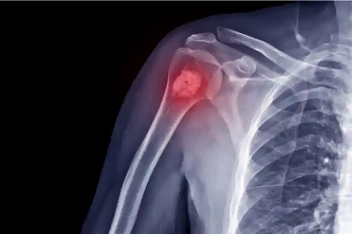 Osteosarcomul la copii este o formă de cancer