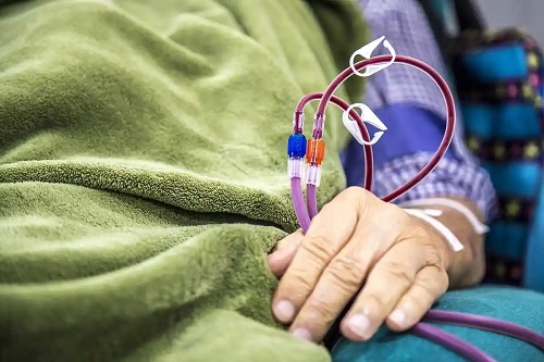 Pacient supus la afereza terapeutică