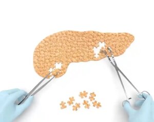 Cauzele, simptomele și tratamentul chisturilor pancreatice