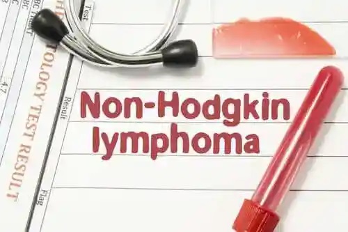 Simptomele și tratamentul limfomului non-Hodgkin