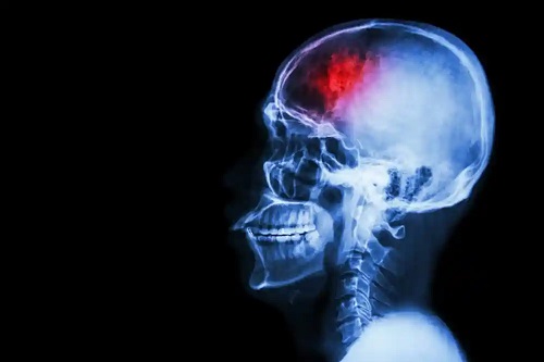 Accident vascular cerebral