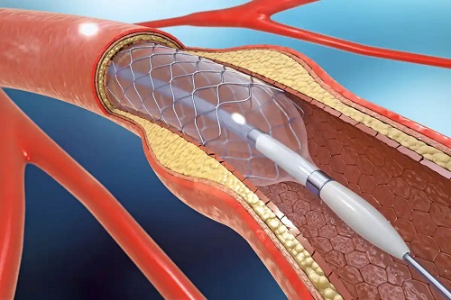 Arteră afectată de arterioscleroză