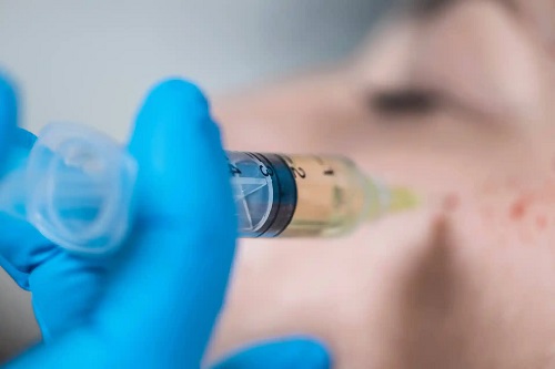 Biostimularea capilară cu plasmă