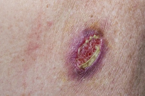 Carcinom bazocelular