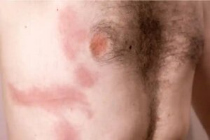 Contuzia costală: cauzele, simptomele și tratamentul