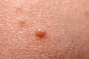 Tratament pentru molluscum contagiosum