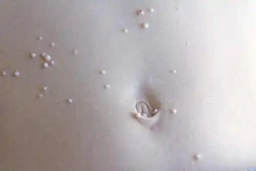 Tratament pentru molluscum contagiosum la copii