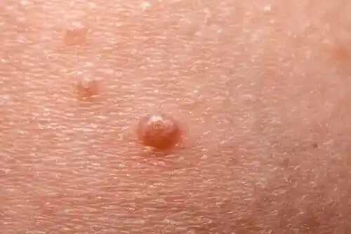 Tratament pentru molluscum contagiosum