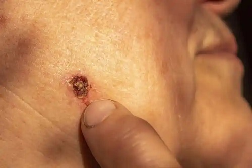 Tratamentul carcinomului bazocelular: cel mai frecvent cancer de piele