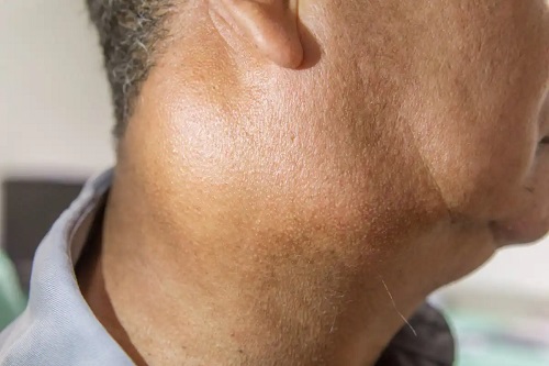 Bărbat care are nevoie de biopsia glandei salivare