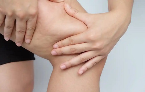 Celulită pe picioare