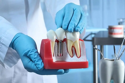 Implanturi dentare