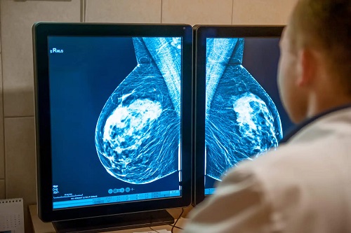 Medic care examinează tumori mamare