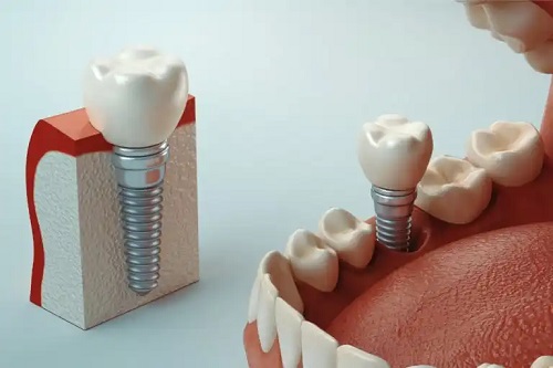 Ce este osteointegrarea implanturilor dentare?