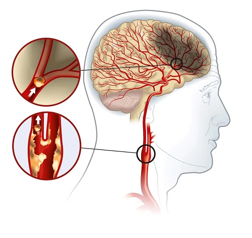 Tratamentul aterosclerozei carotidiene