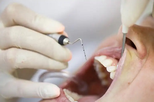 Cum se tratează parodontita sau pioreea?