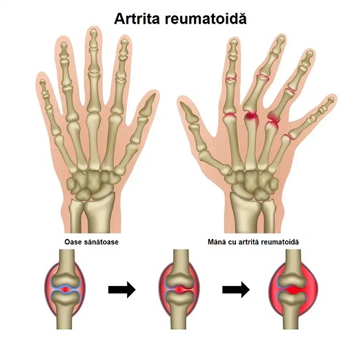 Artrita reumatoidă