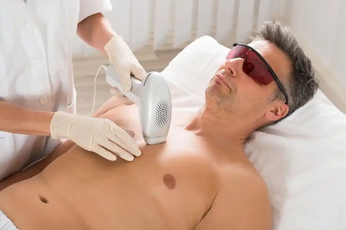 Bărbat epilat cu laser