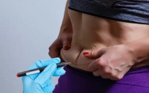 Beneficiile tehnologiei BodyTite pentru pielea flască